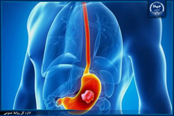 تحقیقات جدید محققان پژوهشگاه رویان جهاددانشگاهی برای تشخیص و پیش‌بینی سرطان معده